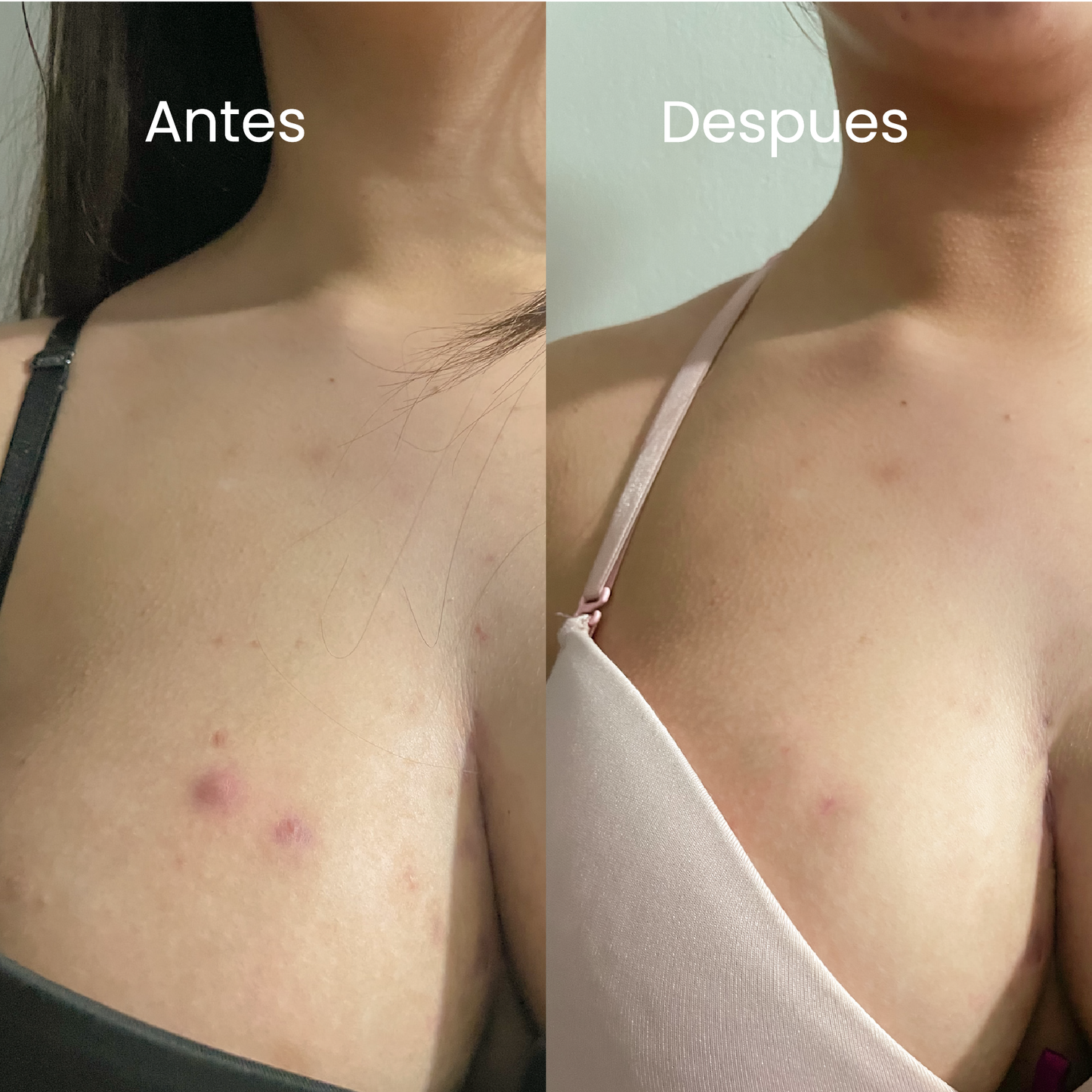 Exfoliante senos & cola Antiacné - 300ml